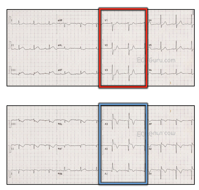 Inferior Wall Mi With Subtle St Elevation Ecg Guru Instructor Resources 6407